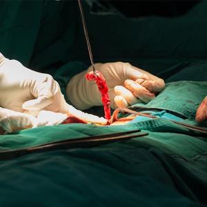 Does appendix removal raise risk of Crohn’s disease?